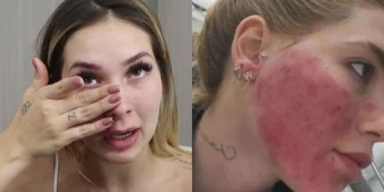 Virginia aparece com rosto em 'carne viva' e choca fãs nas redes após novo procedimento