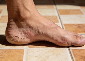 Adicione isso na água e deixe seus pés de molho. Seu calcanhar rachado vai sumir e você vai se agradecer depois