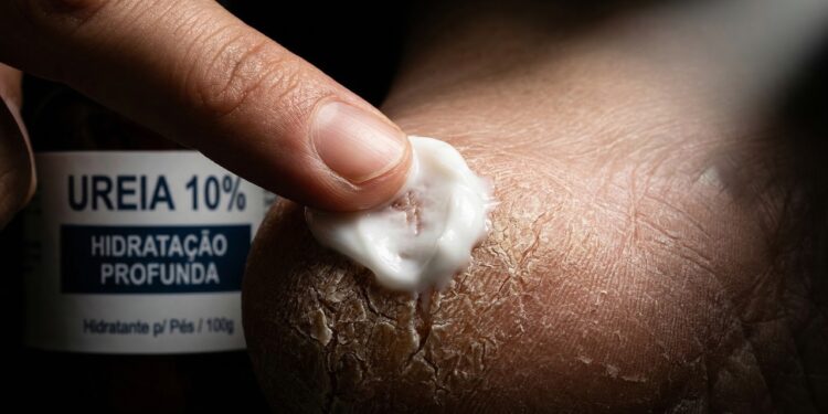 Cremes xodózinhos com ureia a partir de R$ 15 para dar fim aos pés ressecados