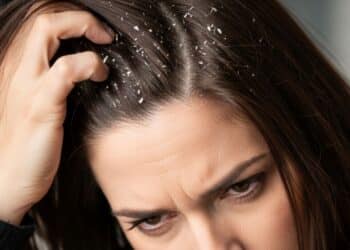 Você vai se livrar de vez das caspas e da coceira no couro cabeludo! Saiaba como fazer o tratamento em casa