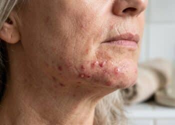 Acne durante a menopausa: uma preocupação da maturidade que requer aconselhamento profissional