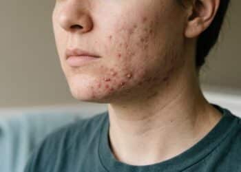 Se você tem problemas de acne, estes produtos recomendados por dermatologistas podem te ajudar