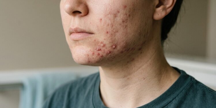 Se você tem problemas de acne, estes produtos recomendados por dermatologistas podem te ajudar